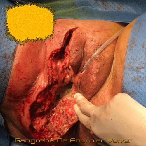 Lymphangiomas : Gangrena de Fournier Vulvar